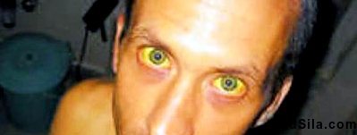 Иктеричность кожи и склер